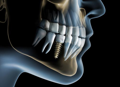 closeup illustration of how a dental implant looks like in a X-ray