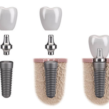 Dental Implant Treatment Possibilities
