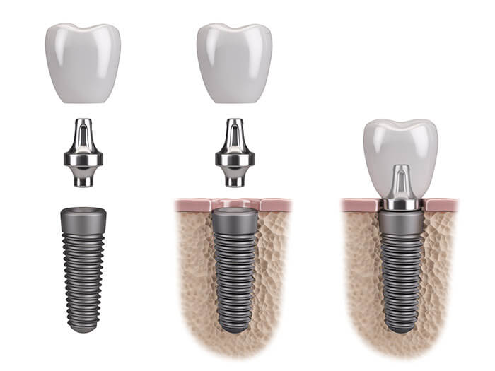 Dental Implant Treatment Possibilities