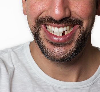 bearded man with a missing bottom tooth