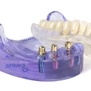 dental implant set