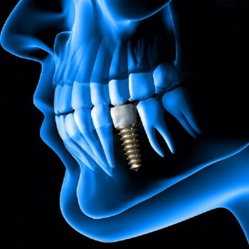 X-ray showing dental implant in patient's mouth