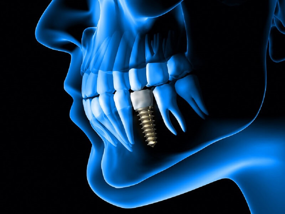 X-ray showing dental implant in patient's mouth