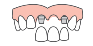 single and multi tooth replacement